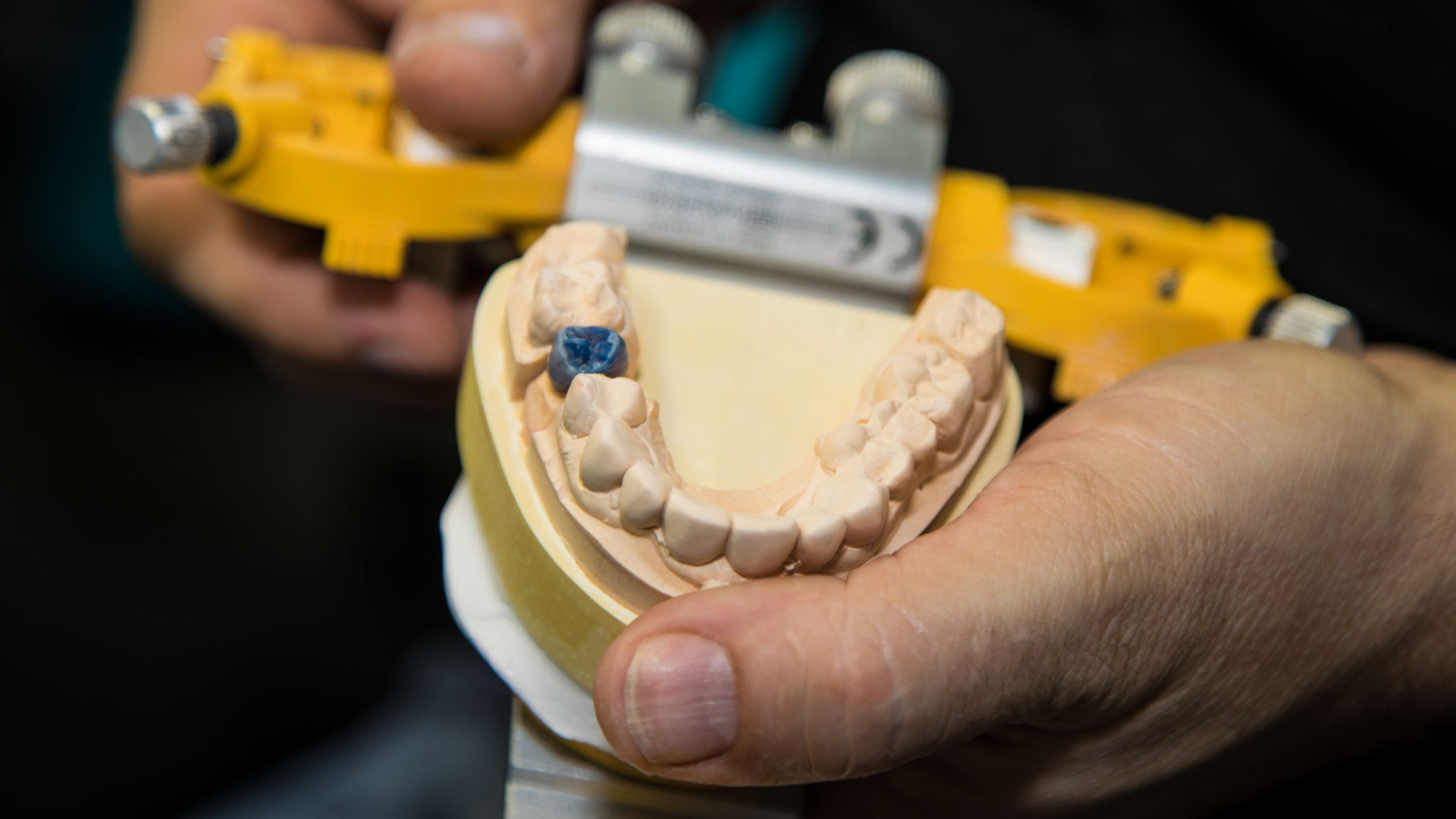 model-implantat Blauer Zahn